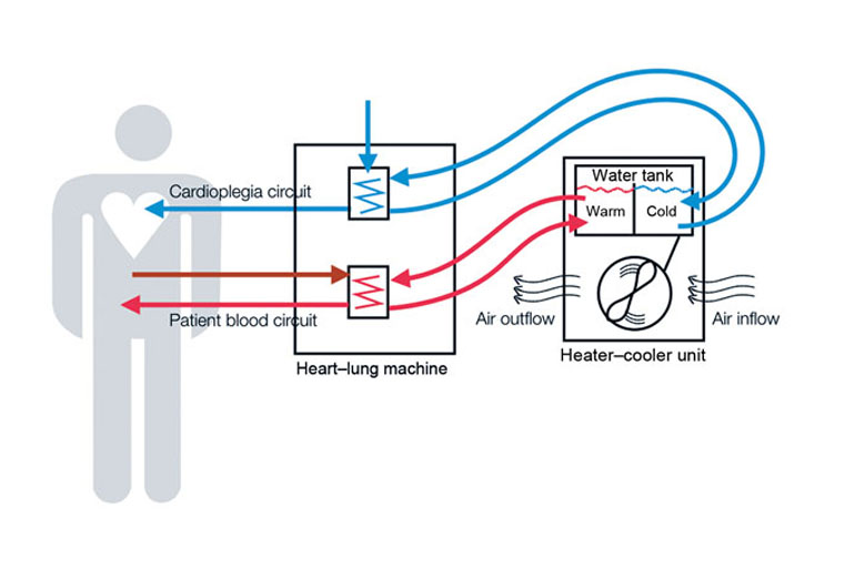 Schematic representation of heater–cooler circuits tested for transmission of Mycobacterium chimaera during cardiac surgery despite an ultraclean air ventilation system. Blue arrows indicate cold water flow, and red arrows indicate hot water flow and patient blood flow. (Courtesy of CDC)