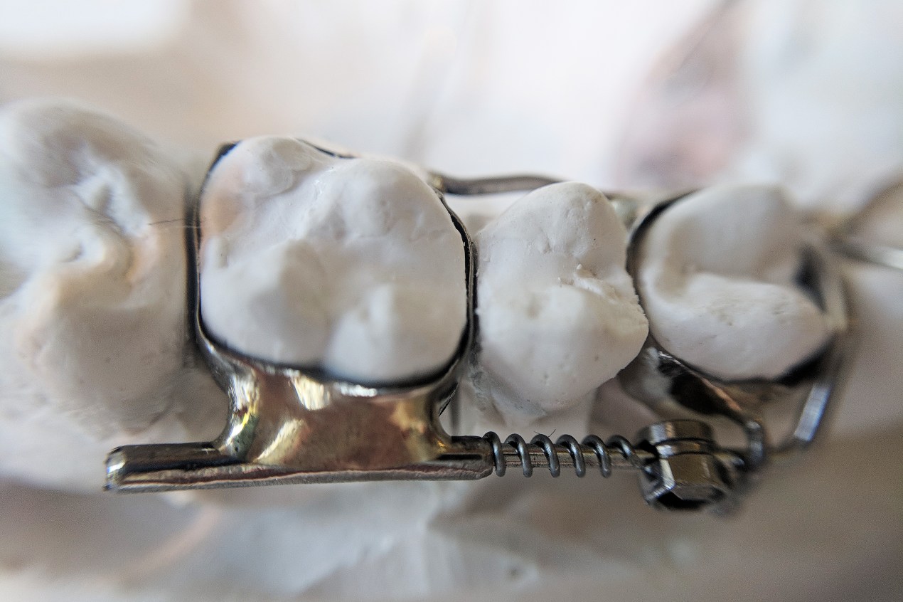 A photo of the AGGA device on a mold of teeth.