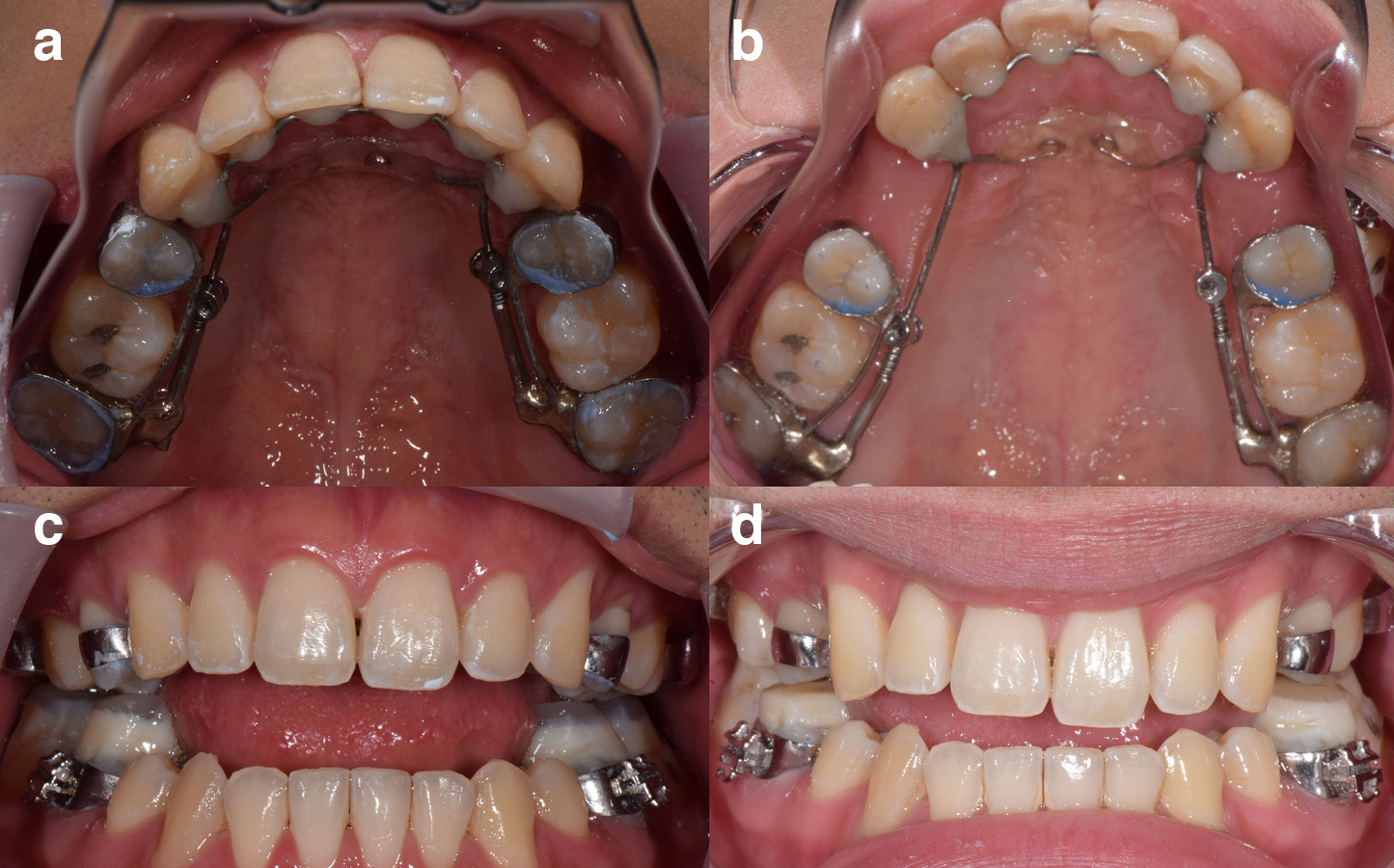 Four photos of a man's teeth while wearing an AGGA device are seen. The photos are labeled A, B, C and D.