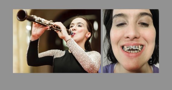 Two photos are shown side by side. The left is of a young woman playing a clarinet at a concert. The right is of the same woman showing her misaligned teeth.